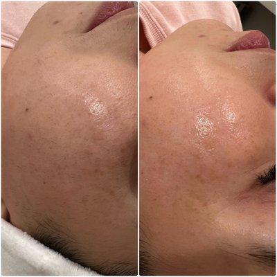 Dermaplaning before & after. Check out that glow!