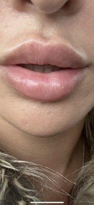 My lips now (after trying to fix the bottom) upper lip lumpy and uneven samara don't take responsibility for this