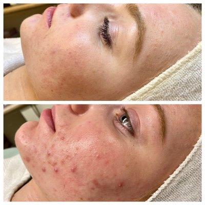 Skin with acne problems