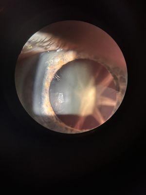 Cataract in my left eye