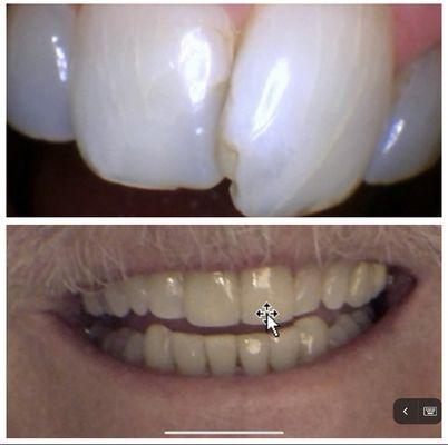 My front two teeth were overlapped and chipped. Without braces, with just 2 veneers, my smile completely transformed!