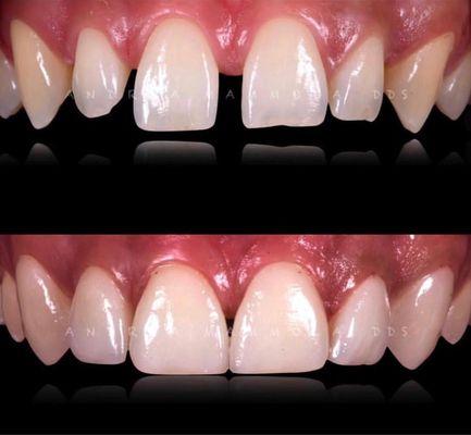 Porcelain Veneers