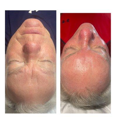 Before and after Hydrafacial