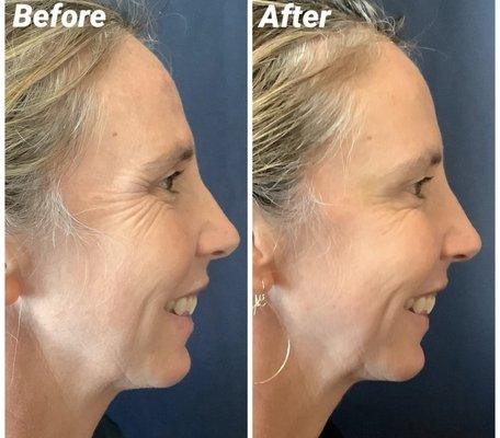 Results from Xeomin injections!