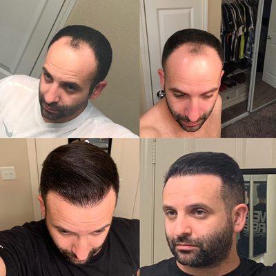 2700 manual FUE grafts before and after 18 months