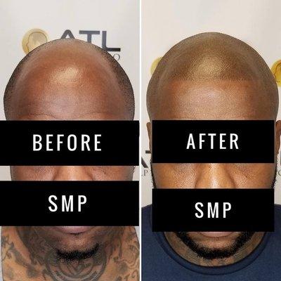 Before and After Best Scalp Micropigmentation Black Men Atlanta GA