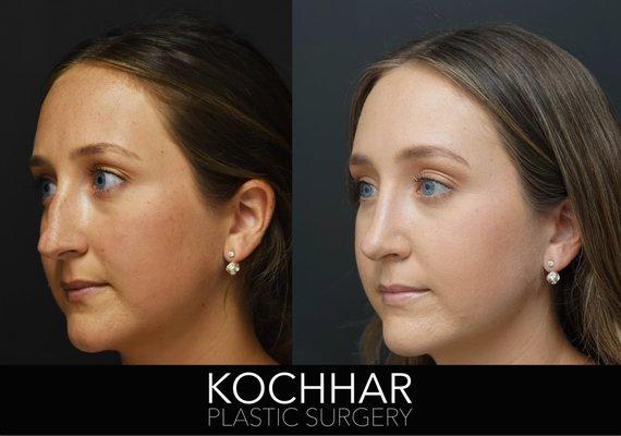 Before and After Rhinoplasty