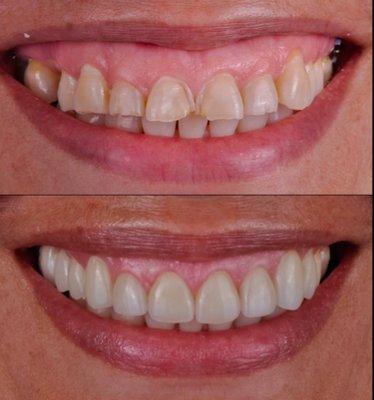 Smile Design Center of Westchester, before and after