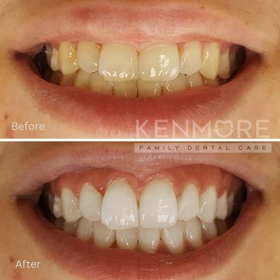 Teeth whitening: several shades of improvement within a 45-minute visit!