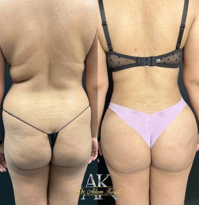 lipo360, fat transfer to buttocks