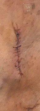 closeup of incision after being sutured