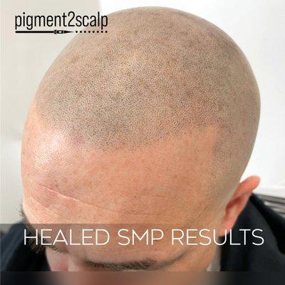 Healed SMP results. Hairline design is a natural look. This look stands the text of time and looks good as you age.