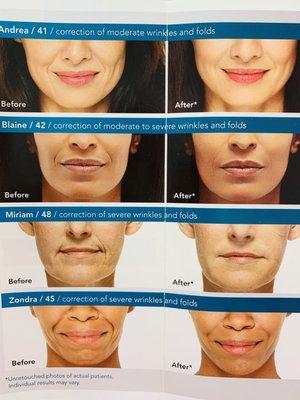 Radiesse: treating unwanted folds and wrinkles-amazing results!