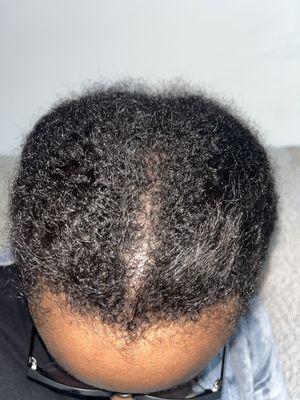 Damaged natural hair with secret relaxer or excessive heat