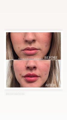 Juvederm lip filler