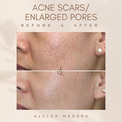 Secret-RF and JuveLook acne scar/enlarged pore treatment.