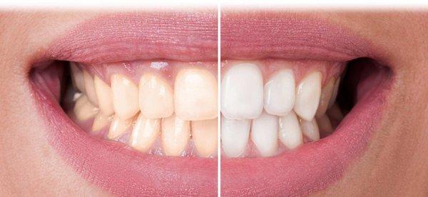 Boost your smile with In-Office or Take Home Bleaching.