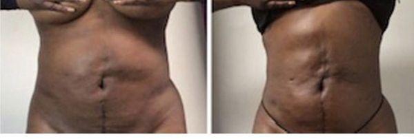 Before and After Post-Op Body Contouring