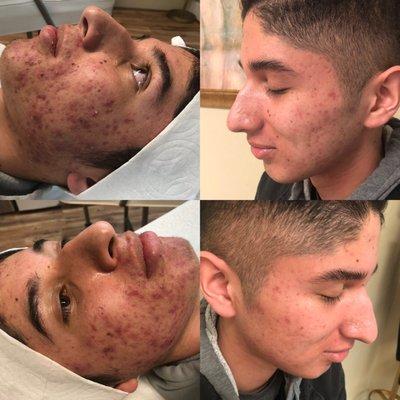 Before and after 2 month Acne treatment