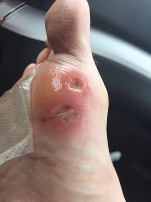 Wounds inflicted on my foot from negligent employee of this salon. Developed cellulitis as a result.