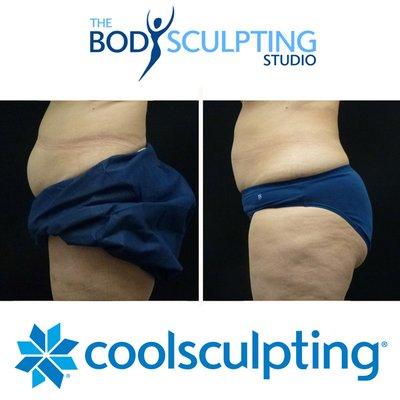 CoolSculpting results from Dr. Melina Jampolis at The Body Sculpting Studio.