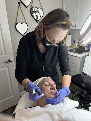 Natalia, Microneedling