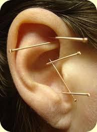 Natural Care Chiropractic offers acupuncture treatment in Huntington, NY.