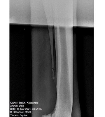 Lateral splint fracture