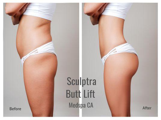 Sculptra Butt Lift