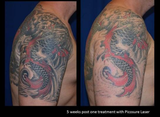 1 Treatment with the PICOSURE Tattoo Removal Laser