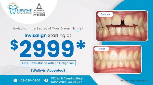 Invisalign start at $2999* - Book Appointment Now