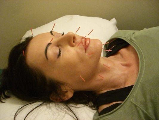 Acupuncture for facial