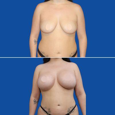 Breast augmentation, liposuction with fat transfer to buttocks 'BBL' - Dr. Stompro