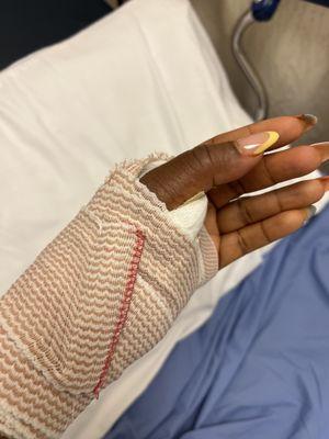 Post-op from trigger finger surgery