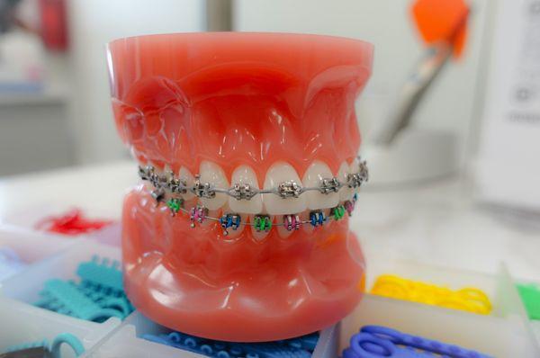 Traditional braces