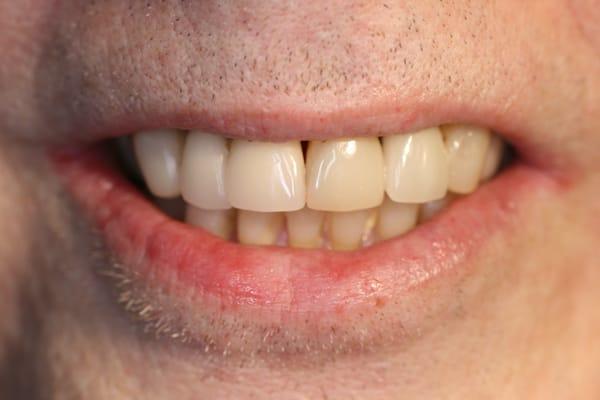 THIS ARE MY FIRST "PORCELAIN VENEERS" DONE IN 1981, THIS PHOTO TAKEN 30 YEARS LATER in 2011, notice still doing great!