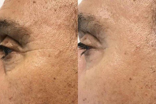 Botox applied to crows feet lines. Before and immediately after the procedure.