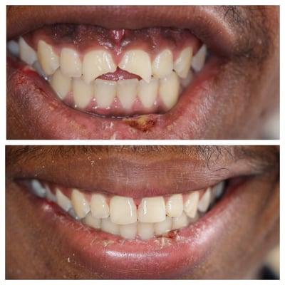 Patient came in with 2 broken front teeth, after an hour in chair Dr. Aaron's results speak for themselves.