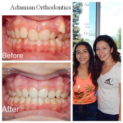 Congratulations Jasmine! Enjoy your new smile. Braces off!