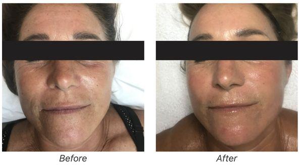 BodyLab Med Spa Clinical Facial results