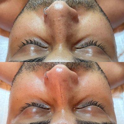 Deep pore cleansing facial