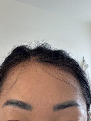 inner corner of brows (before) 1 treatment