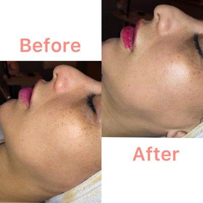 Buccal Lymphatic Lift and Glow