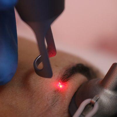 Eyebrows Laser Tattoo Microblading Removal