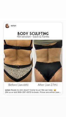 Body contouring