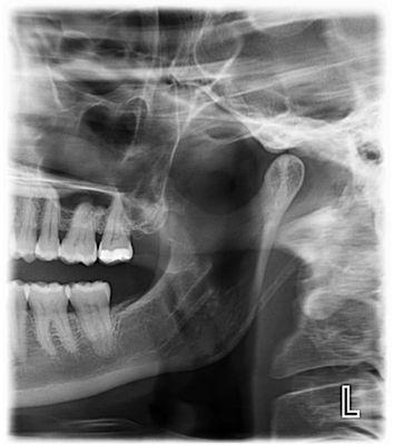 See for yourself, this is where they said root canals were needed.  Total Phooey!