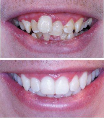 A complete smile transformation by restorative dentistry, Invisalign, whitening, and periodontal hygiene. We are so proud of this patient!