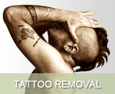 Tattoo Removal