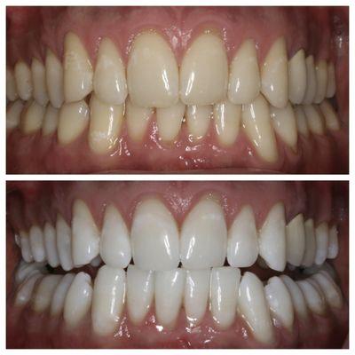 The Best teeth Whitening system is provided at Divine Smiles !