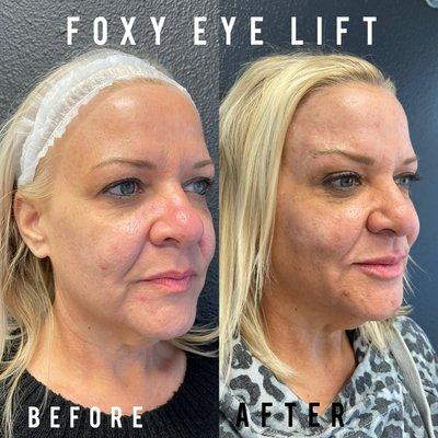 Non Surgical Eyebrow Lift